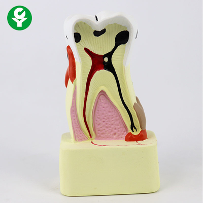 O modelo dental dos dentes da comparação da cárie/demonstração dental modela ensinando